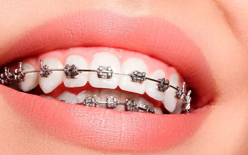 Ortodoncia (adultos y niños)