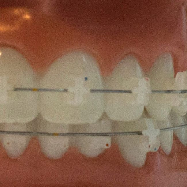 Ortodoncia dental en Oviedo