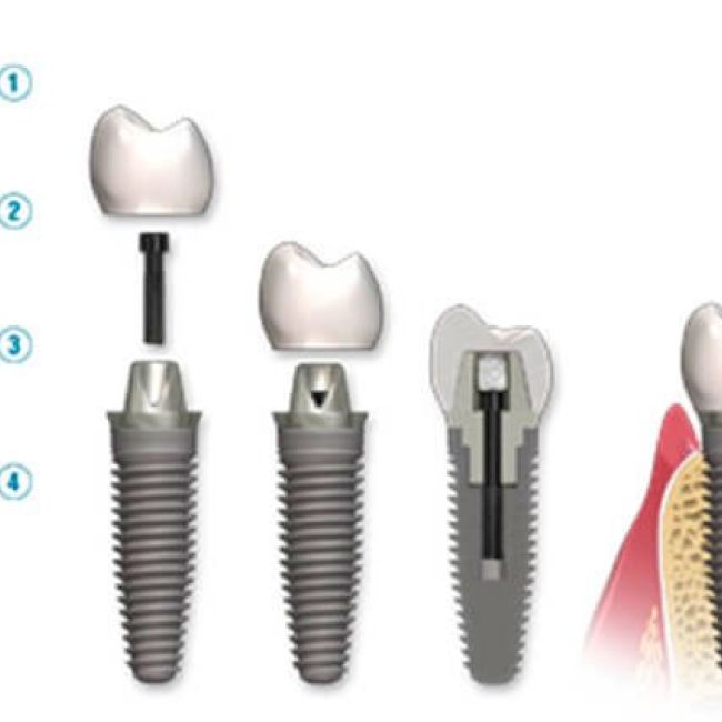 Implantes dentales