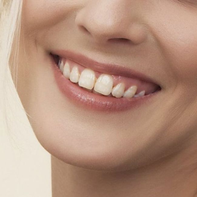 Blanqueamiento dental