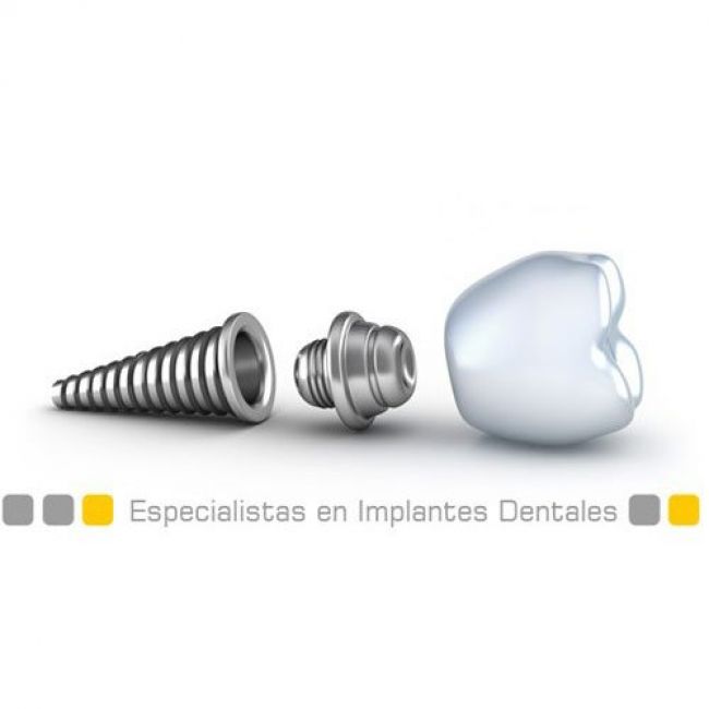 Implantología en Oviedo