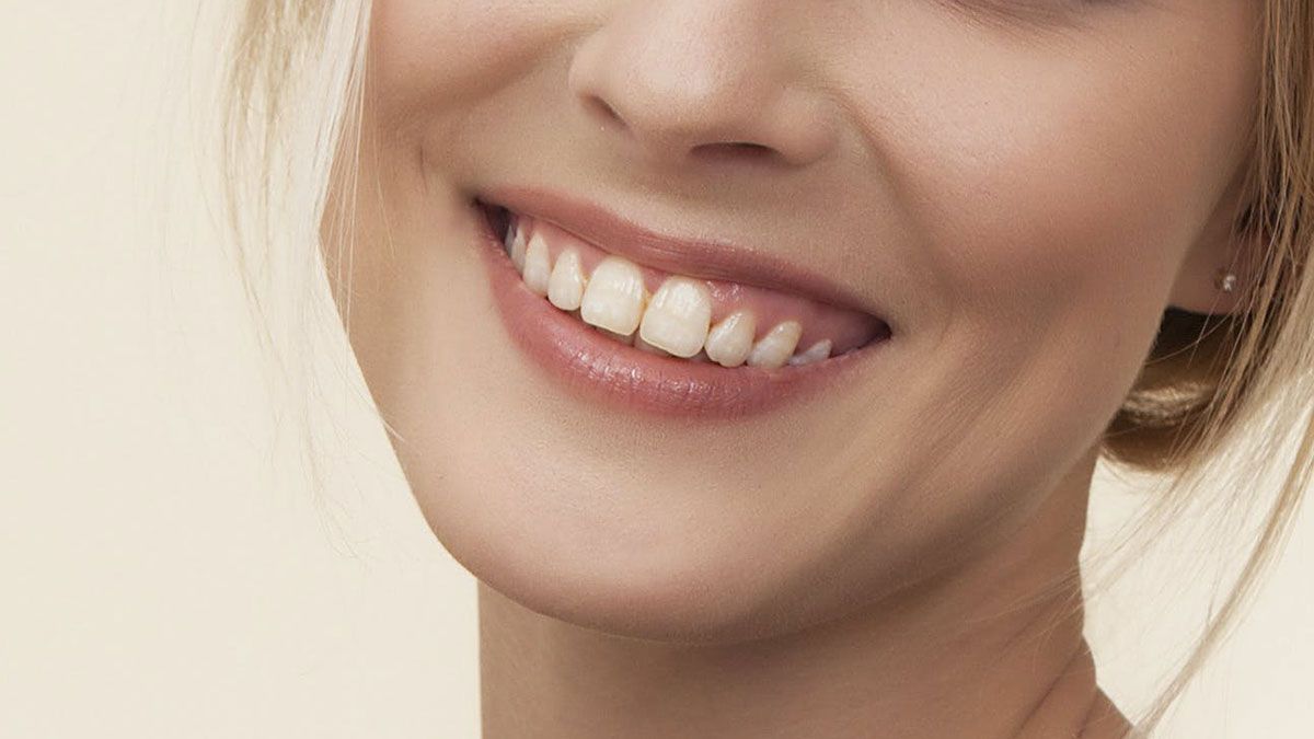 Blanqueamiento dental